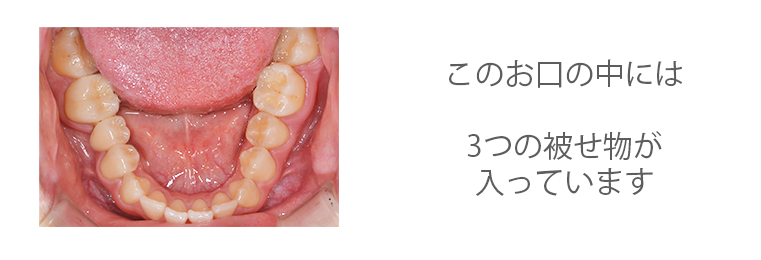 オールセラミックスによる審美治療1