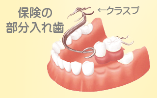 保険義歯