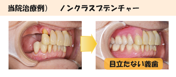 ノンクラスプ治療例