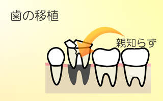 歯の移植