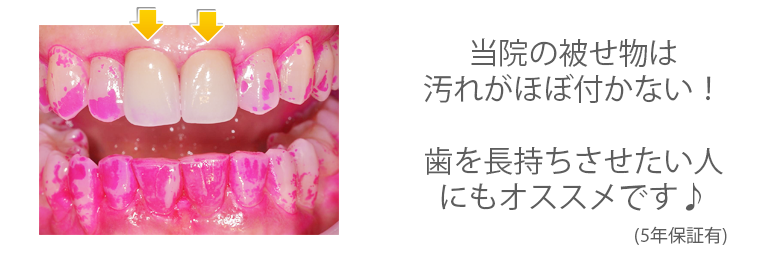 オールセラミックスによる審美治療2