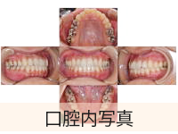 口腔内写真