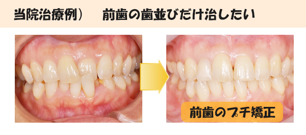 プチ矯正治療例